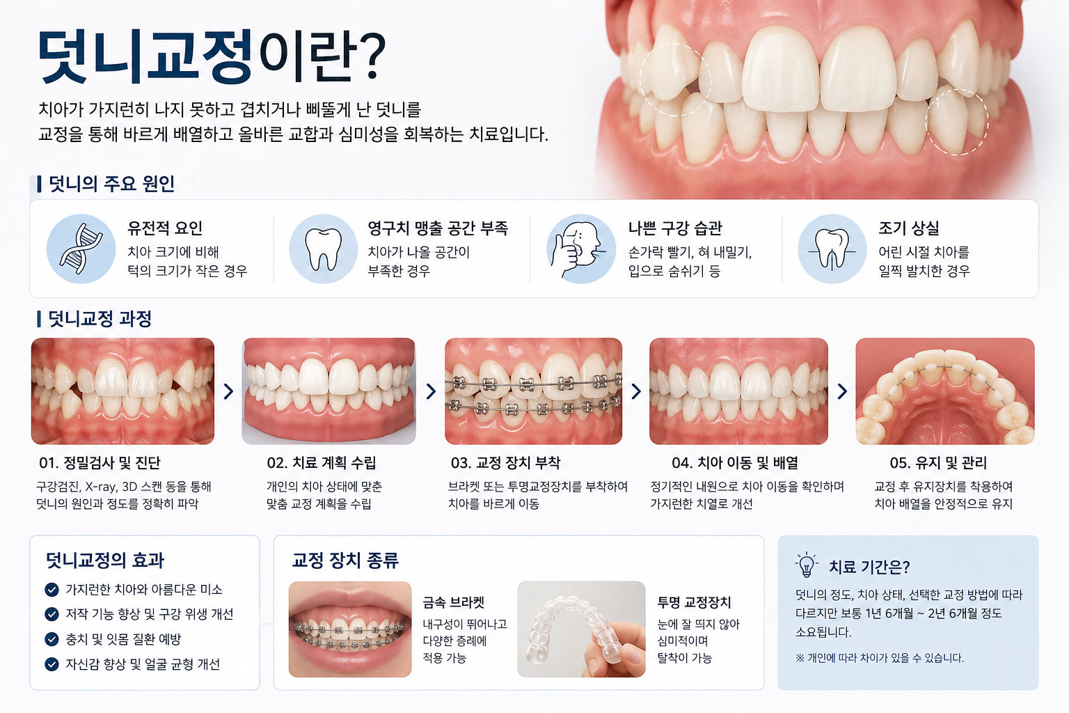 부천 덧니 교정 치아가 겹쳐 나거나 삐뚤어진 덧니 상태 설명 연세바로치과 치과교정과 전문의